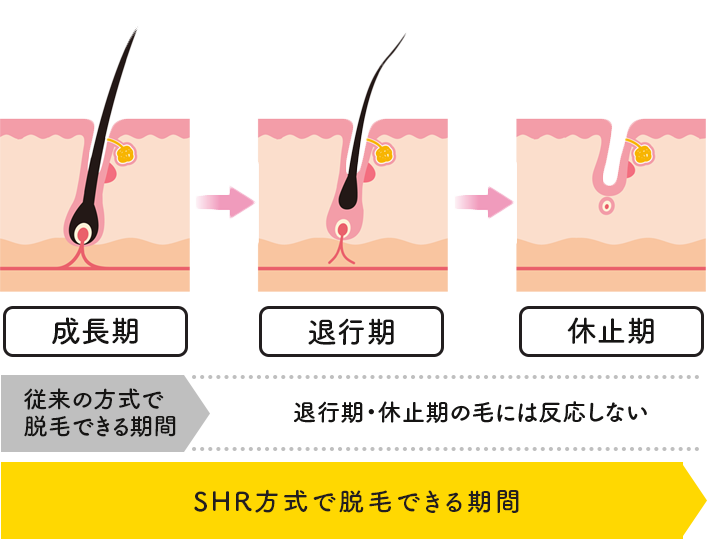 SHR方式で脱毛できる期間の図